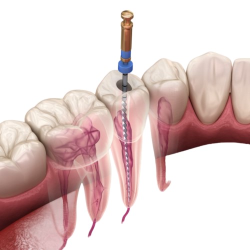 Best dentist for root canal treatment in hinjewadi Mahalunge Maan Pune