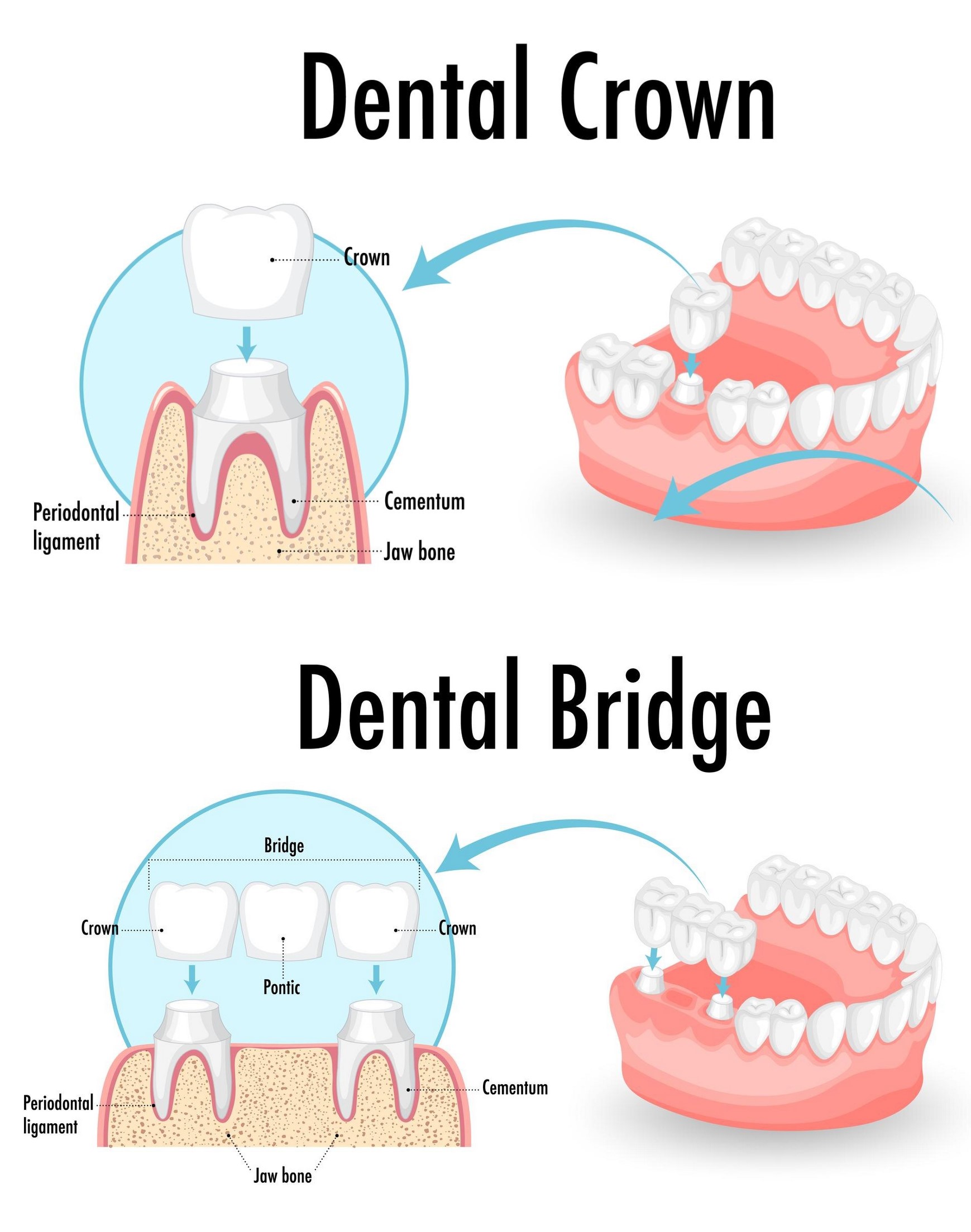 Best dentist and dental clinic for dental crowns and dental bridges in hinjewadi Mahalunge Maan Pune