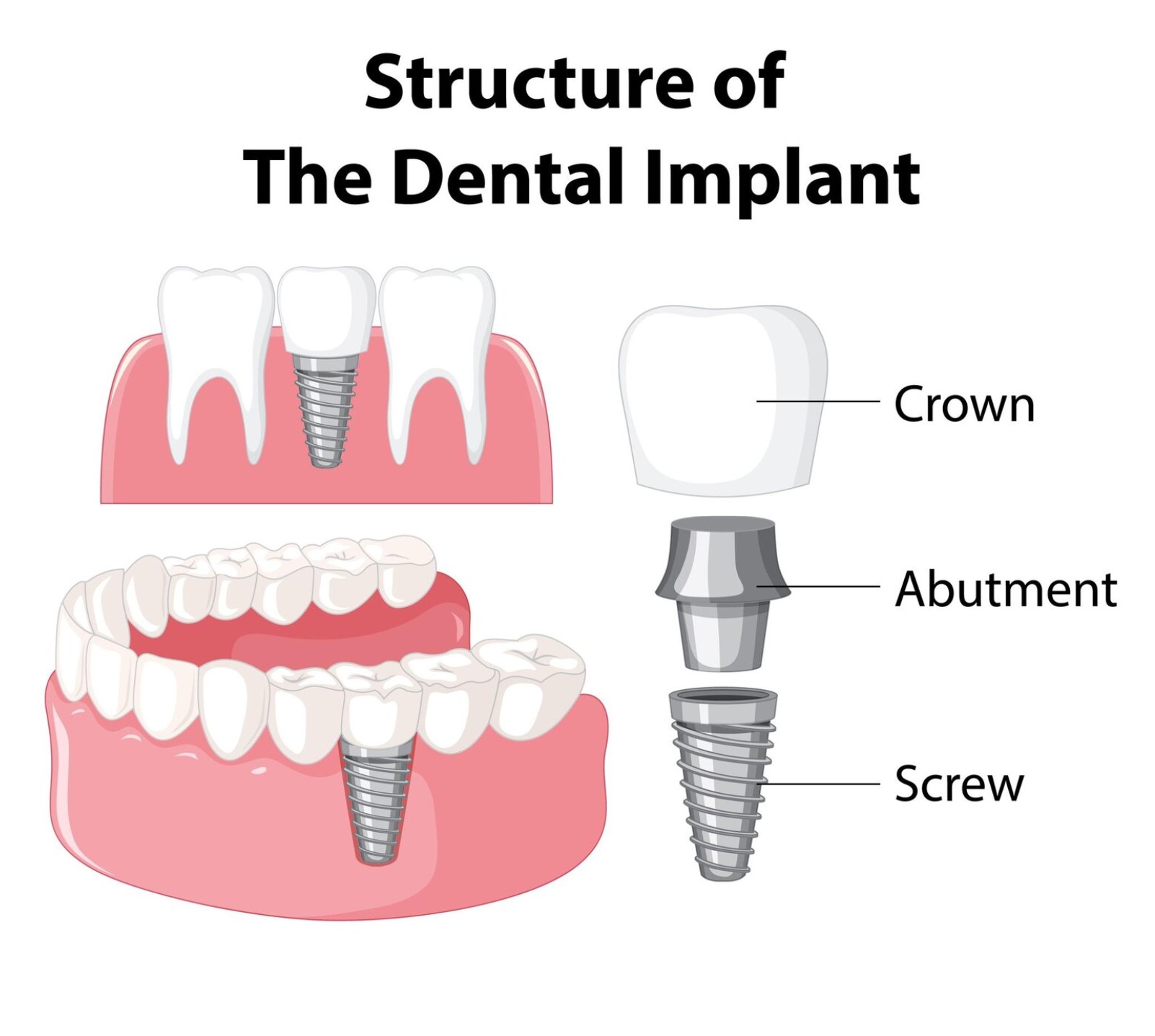 Best dentist and best dental clinic for dental implant treatment in hinjewadi Mahalunge Maan Pune