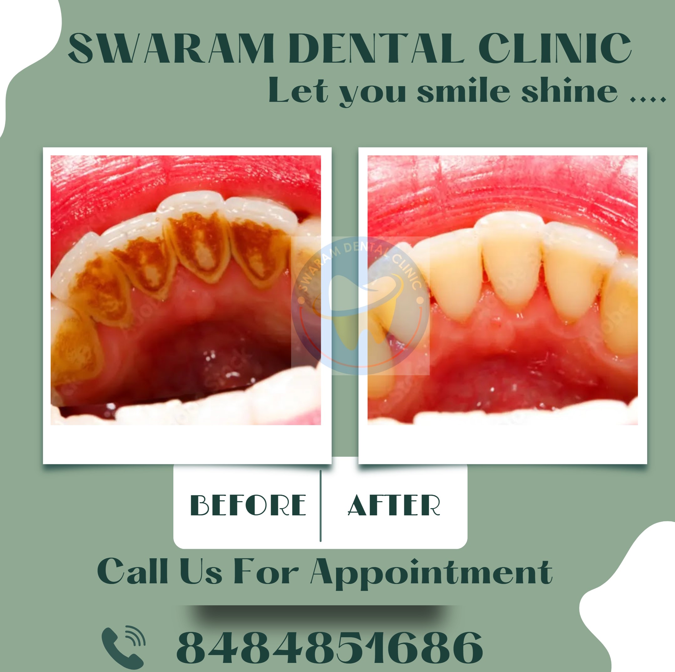Best Teeth Cleaning and Polishing By Swaram Dental Clinic Hinjewadi Pune