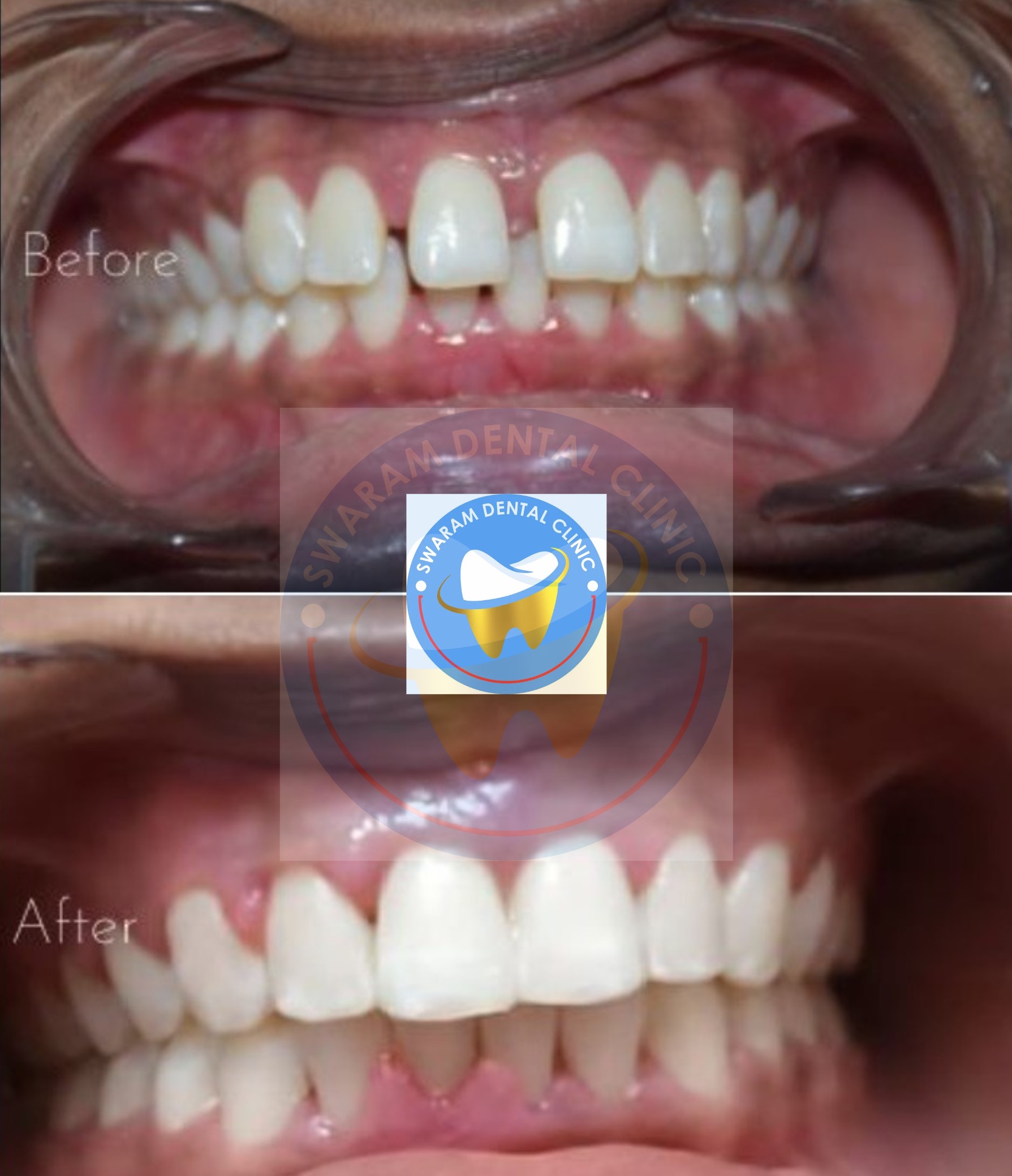 Best Dentist Near Maan Hinjewadi Swaram Dental Clinic