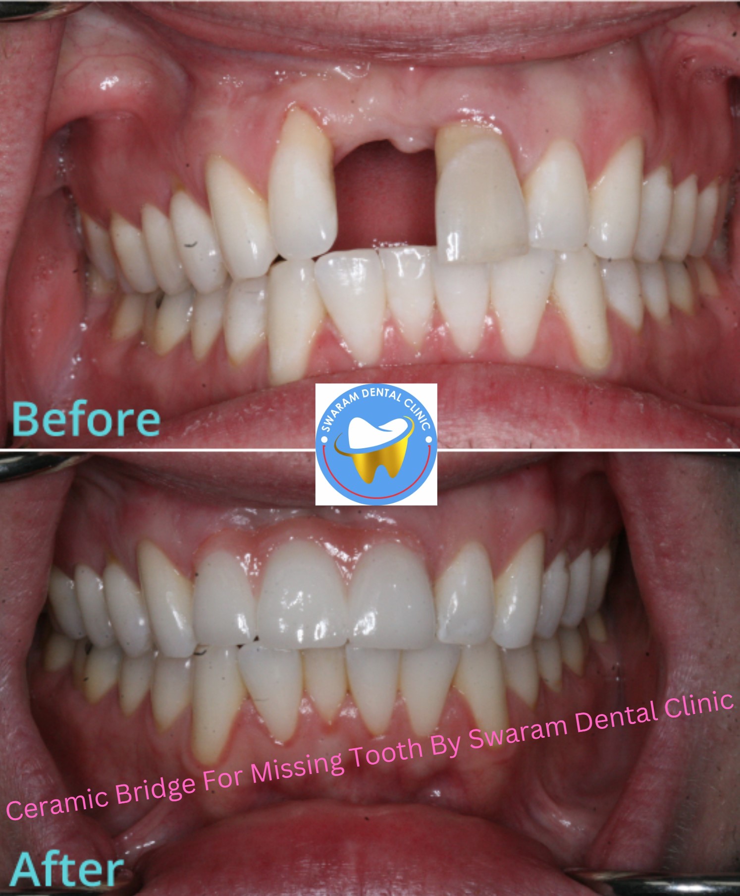 Ceramic Bridge By Swaram Dental Clinic Maan Rd Hinjewadi Pune