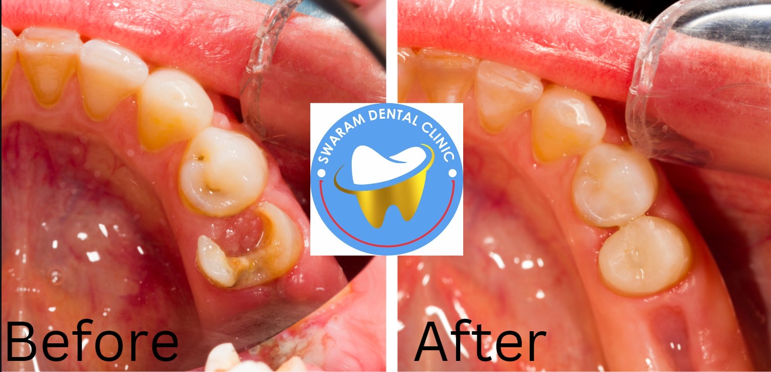 Decayed Tooth Restoration by Doing Root Canal Treatment from Swaram Dental Clinic Best Dentist in Hinjewadi Maan Pune