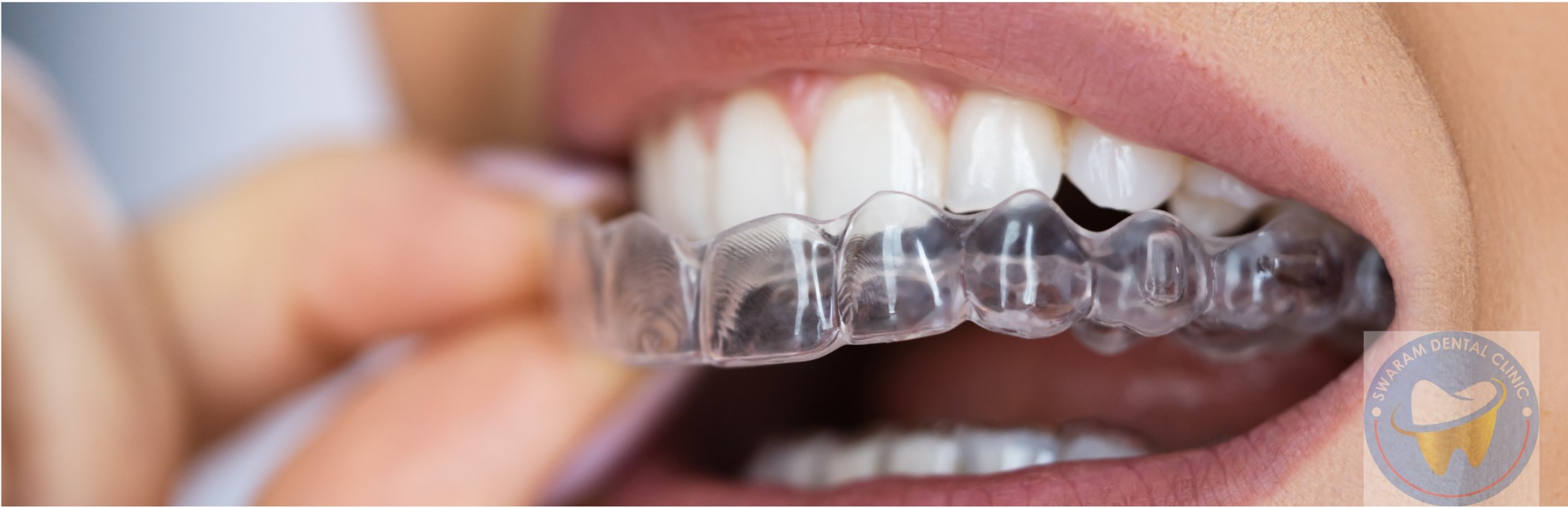 Invisible Aligners from Swaram Dental Clinic Best Orthodontic Clinic in Hinjewadi