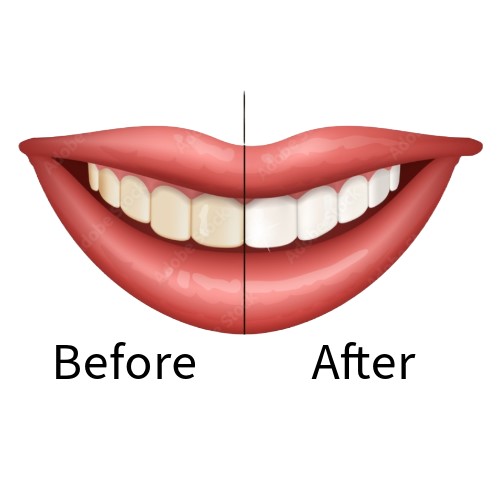 Teeth Whitening Before and After at Swaram Dental Clinic