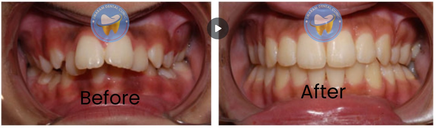 Teeth Straightening by Swaram Dental Clinic - Dental Clinic in Hinjewadi